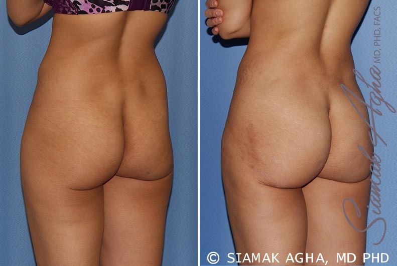 Tummy Tuck Before & After