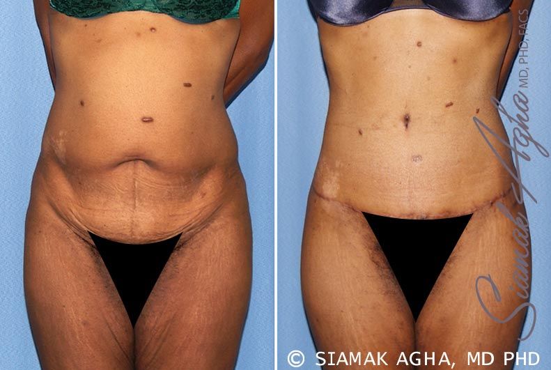 Tummy Tuck Before & After