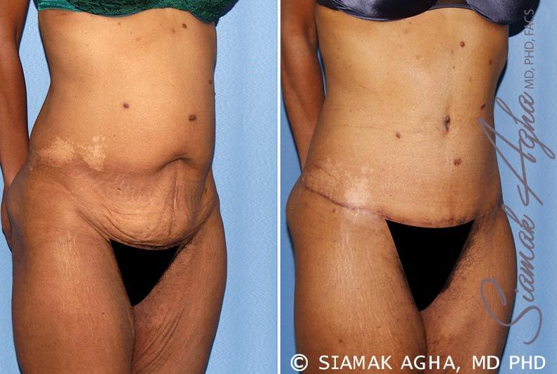 Tummy Tuck Before & After