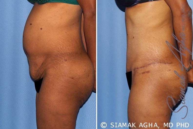 Tummy Tuck Before & After