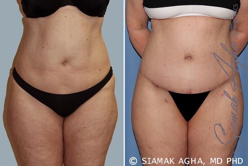 Tummy Tuck Before & After