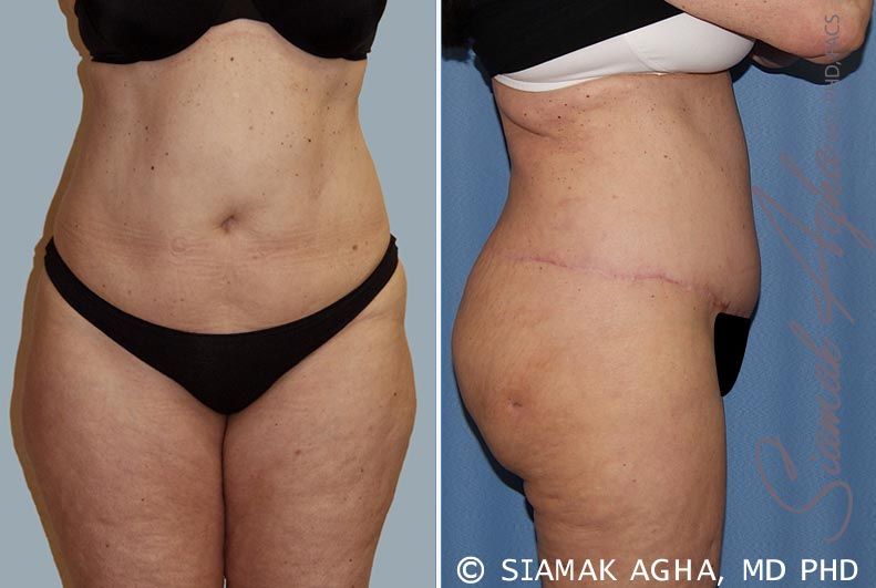 Tummy Tuck Before & After