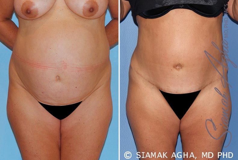 Tummy Tuck Before & After