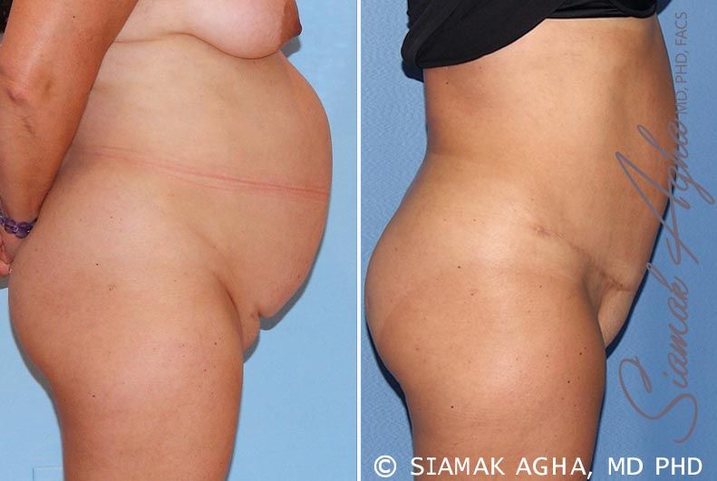 Tummy Tuck Before & After