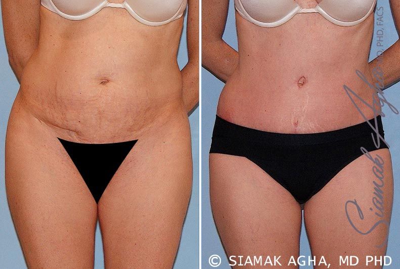 Tummy Tuck Before & After