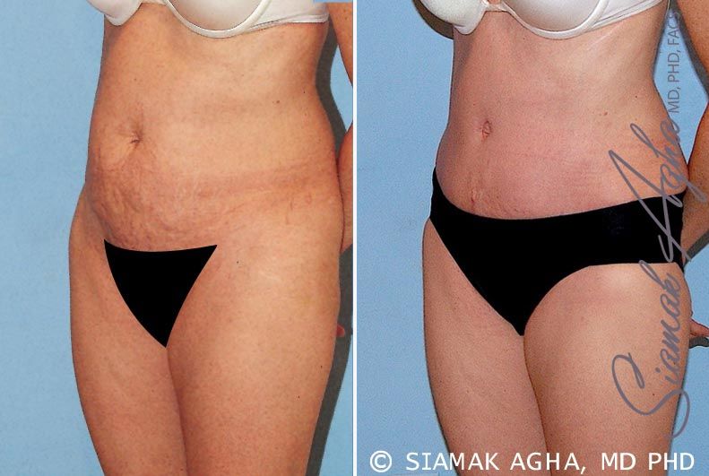 Tummy Tuck Before & After