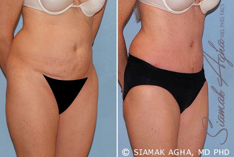 Tummy Tuck Before & After