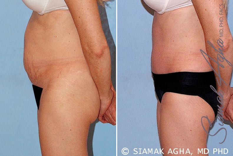 Tummy Tuck Before & After