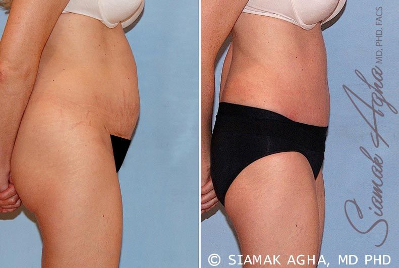 Tummy Tuck Before & After