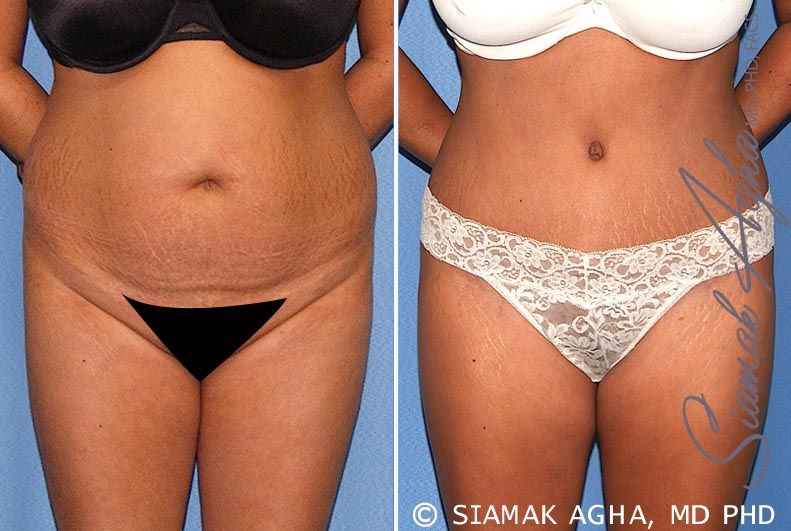 Tummy Tuck Before & After