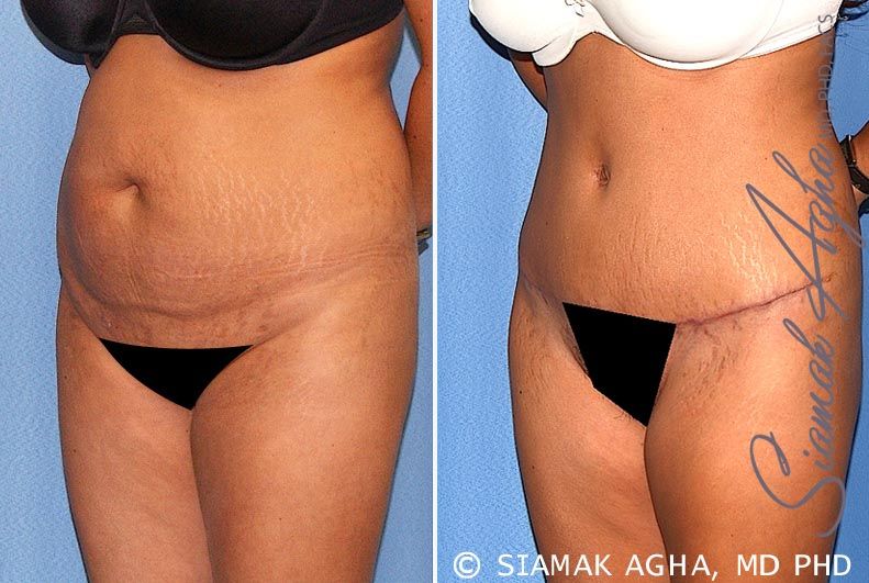Tummy Tuck Before & After