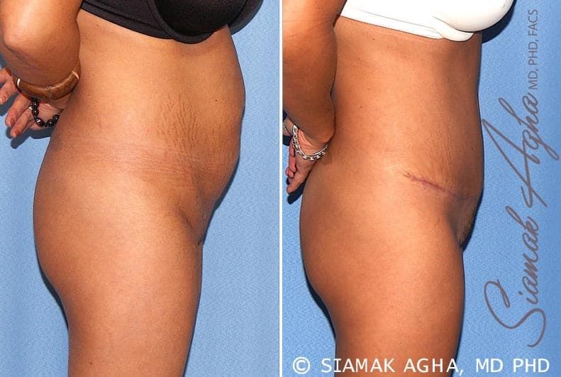 Tummy Tuck Before & After