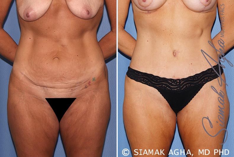 Tummy Tuck Before & After