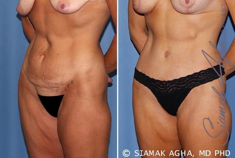 Tummy Tuck Before & After