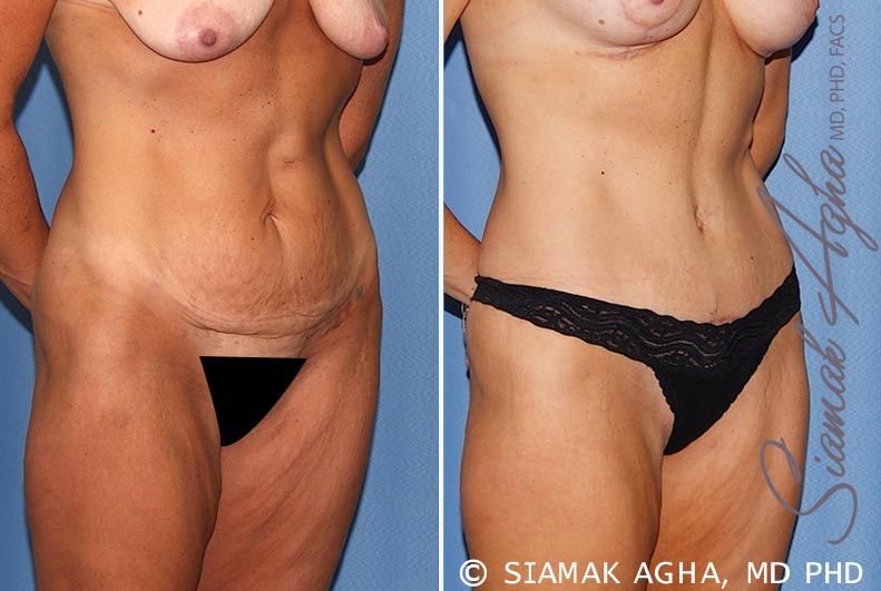 Tummy Tuck Before & After