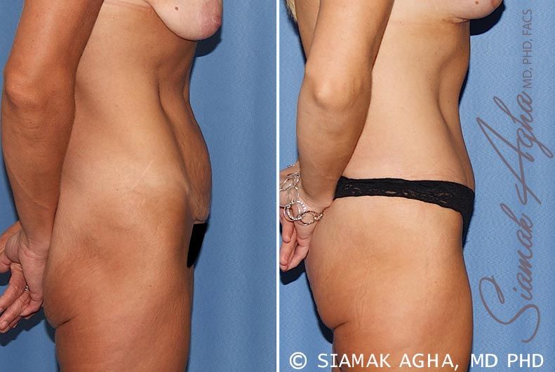 Tummy Tuck Before & After