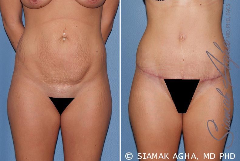 Tummy Tuck Before & After