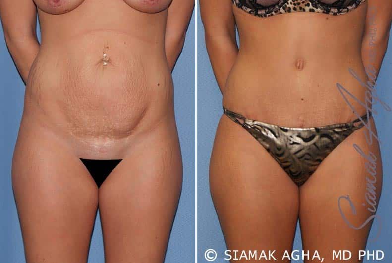 Tummy Tuck Before & After