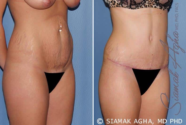 Tummy Tuck Before & After