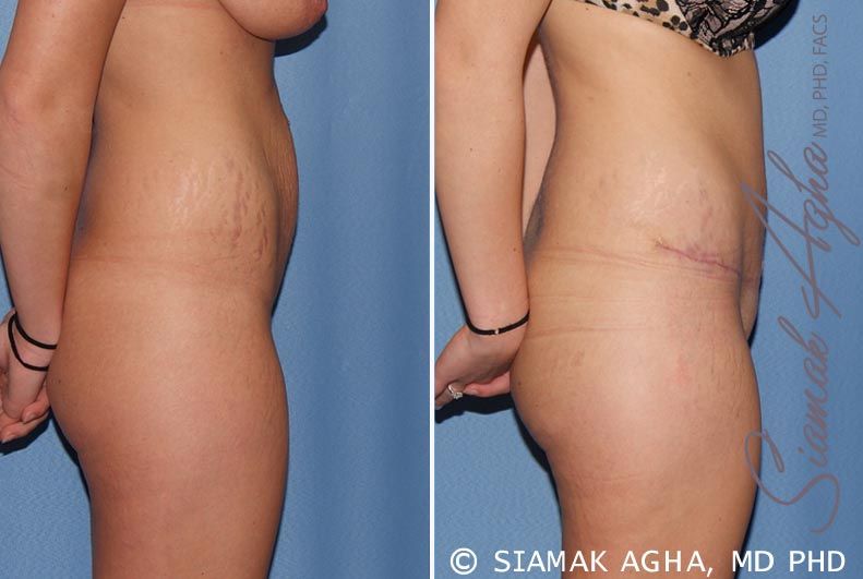 Tummy Tuck Before & After