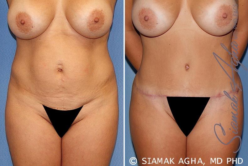 Tummy Tuck Before & After