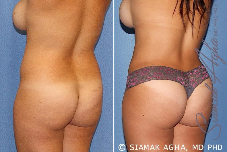 Tummy Tuck Before & After