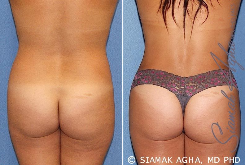 Tummy Tuck Before & After