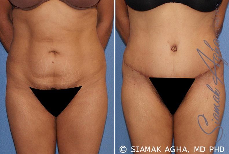 Tummy Tuck Before & After