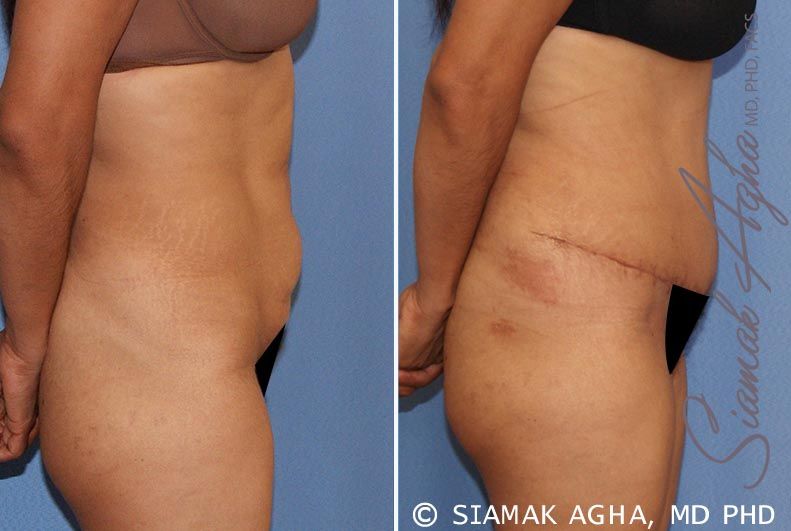 Tummy Tuck Before & After
