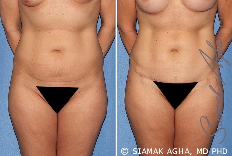 Tummy Tuck Before & After
