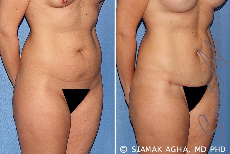 Tummy Tuck Before & After