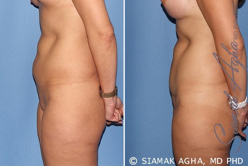 Tummy Tuck Before & After