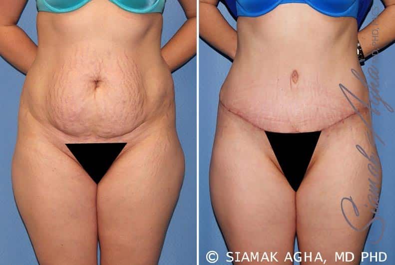 Tummy Tuck Before & After