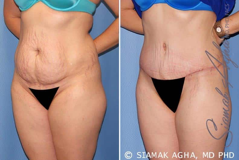 Tummy Tuck Before & After