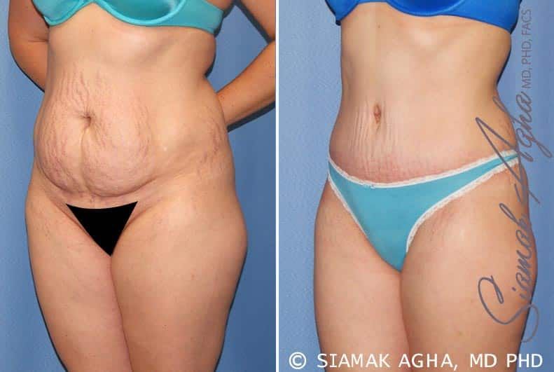 Tummy Tuck Before & After