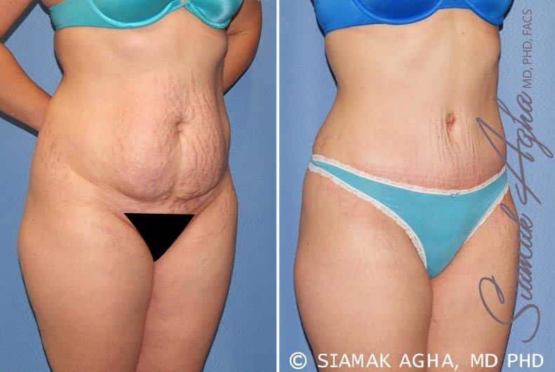 Tummy Tuck Before & After