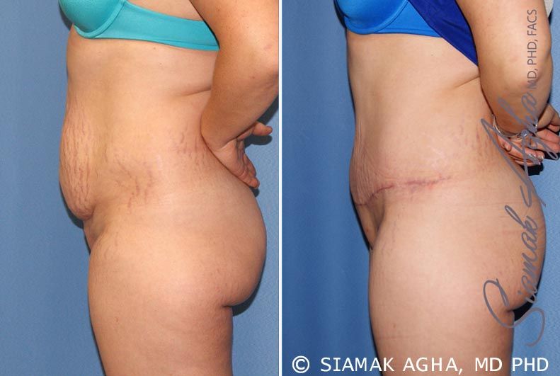 Tummy Tuck Before & After