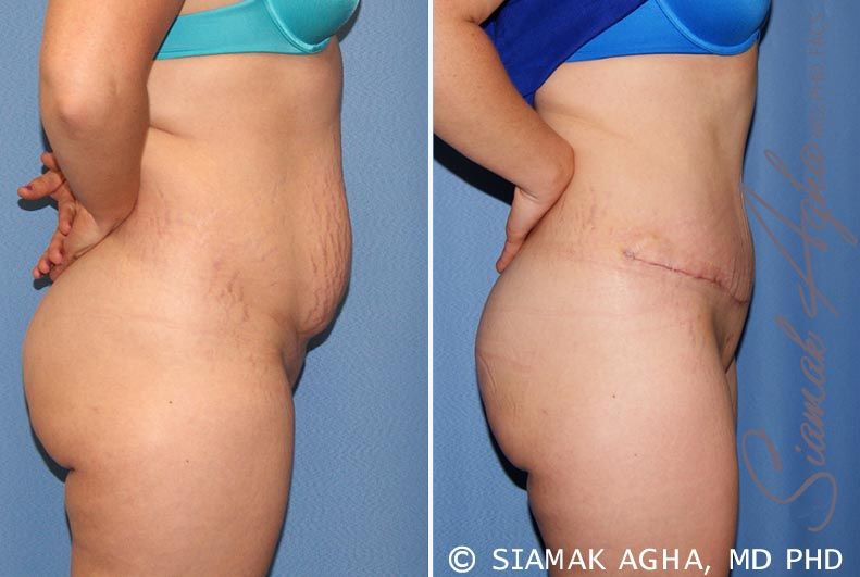 Tummy Tuck Before & After