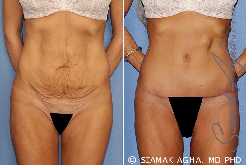 Tummy Tuck Before & After