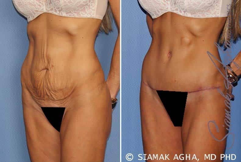 Tummy Tuck Before & After