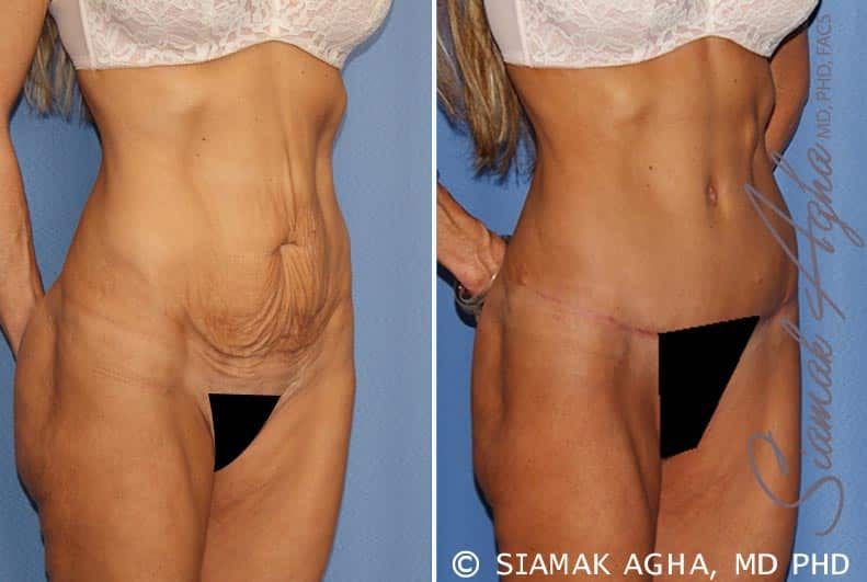 Tummy Tuck Before & After