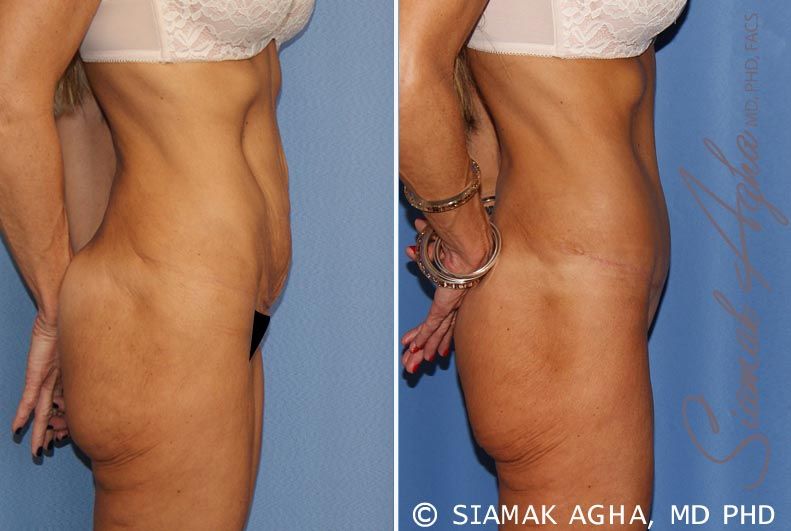 Tummy Tuck Before & After