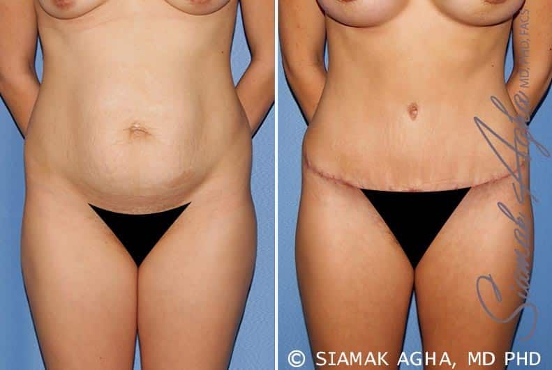 Tummy Tuck Before & After