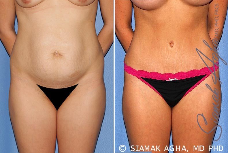 Tummy Tuck Before & After