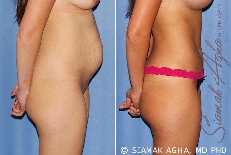 Tummy Tuck Before & After