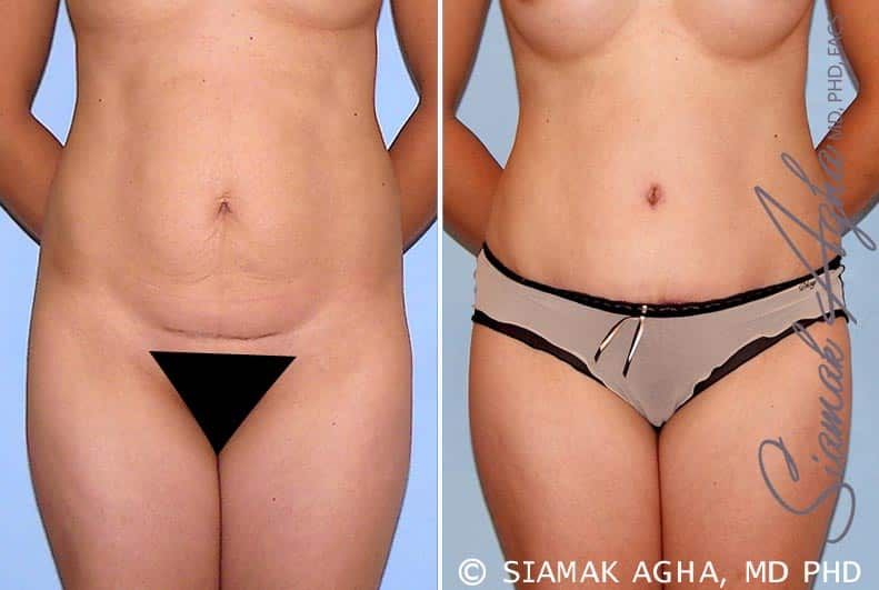 Tummy Tuck Before & After