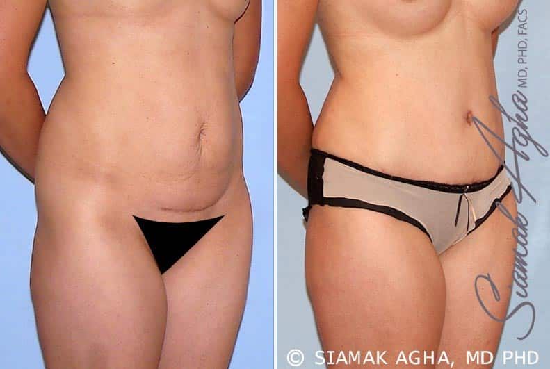 Tummy Tuck Before & After