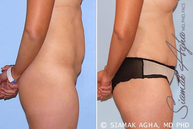 Tummy Tuck Before & After
