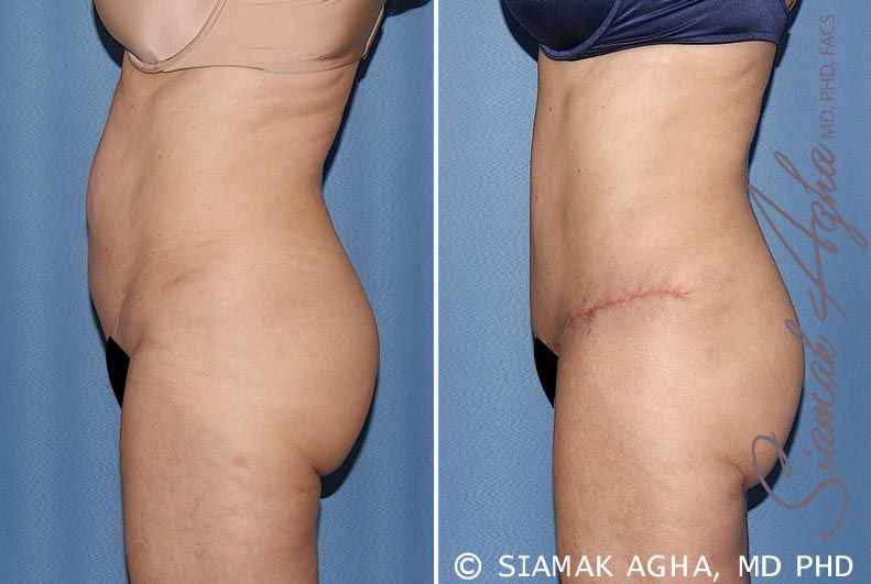 Tummy Tuck Before & After