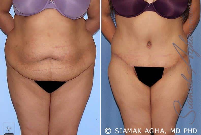 Tummy Tuck Before & After